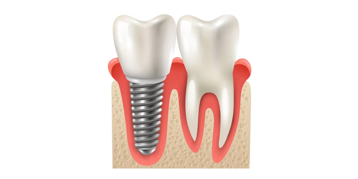 Dental Implants