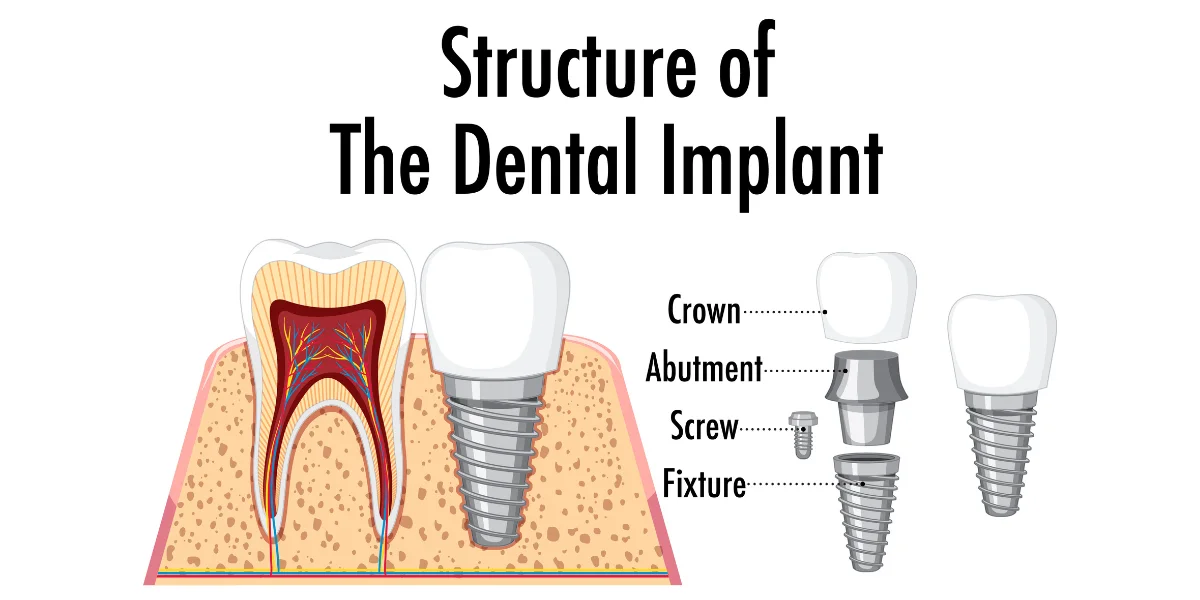Facts About Dental Implants