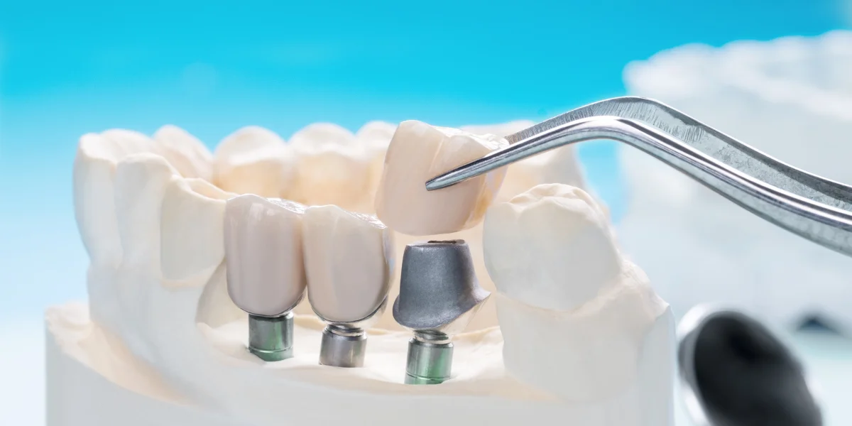 Dental Implants Clinic