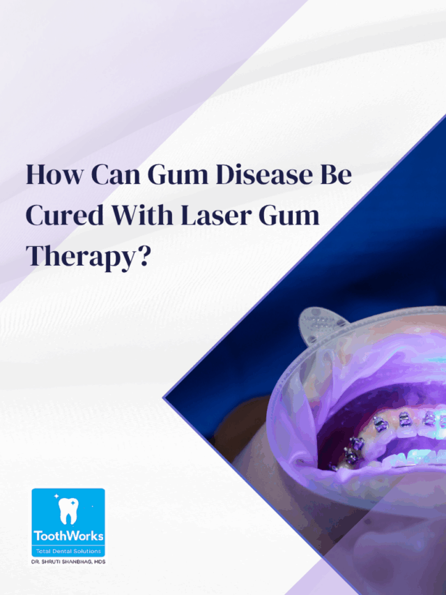 Laser Gum Treatment