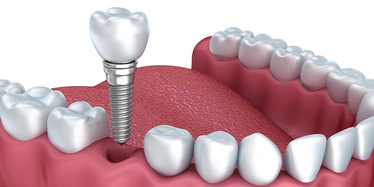 Full Mouth Dental Implants