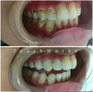 Smile Makeover 1