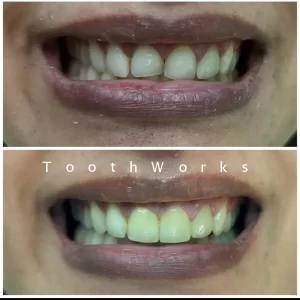 Smile Makeover 13