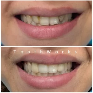 Smile Makeover 5