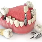 Full Mouth Dental Implants