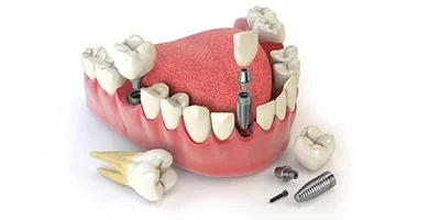 Full Mouth Dental Implants