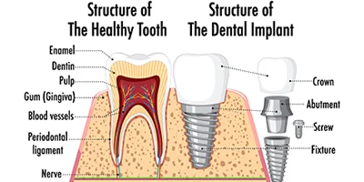 Facts About Dental Implants