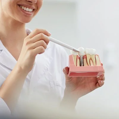 Dental Implants for Full Mouth