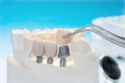 Dental Implants Clinic