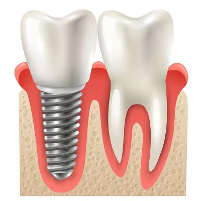Dental Implants