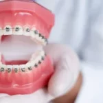 Orthodontics Dental Treatment