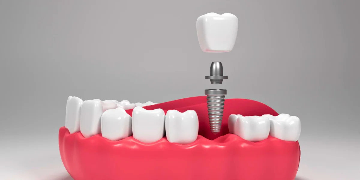 Dental Implants for Oral Health