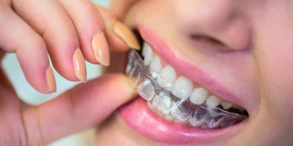 Invisalign treatment