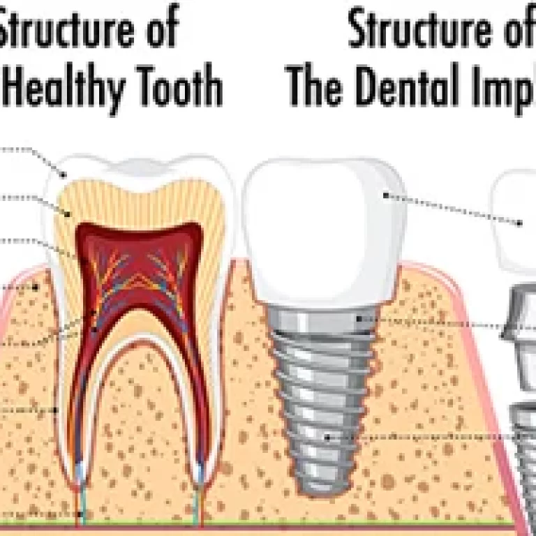 Facts About Dental Implants