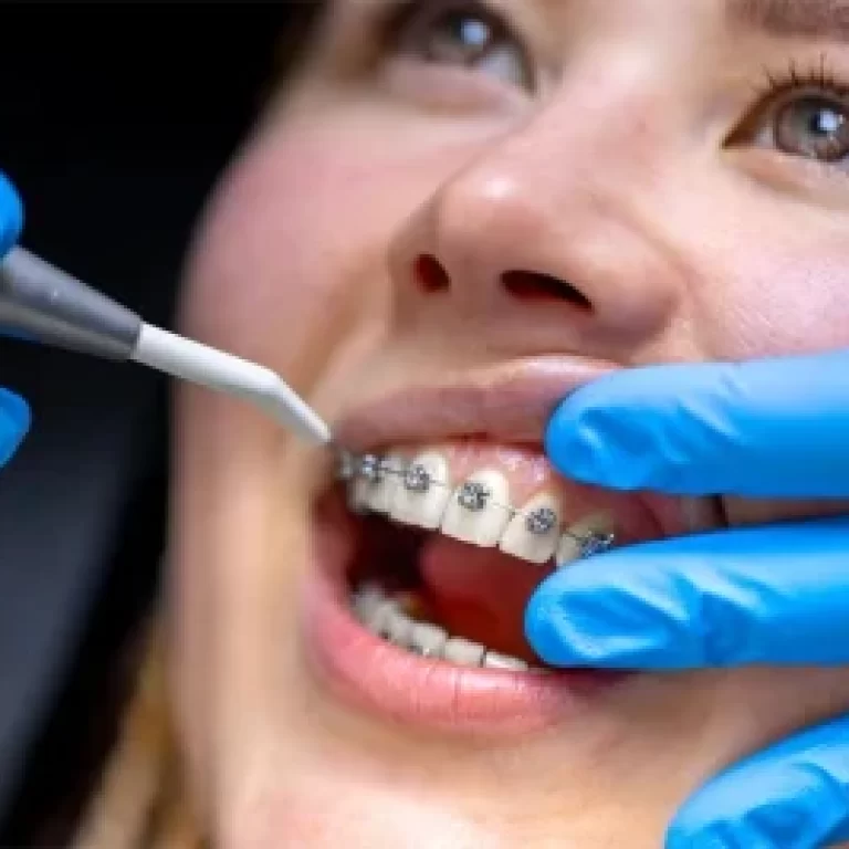 Orthodontic Treatment