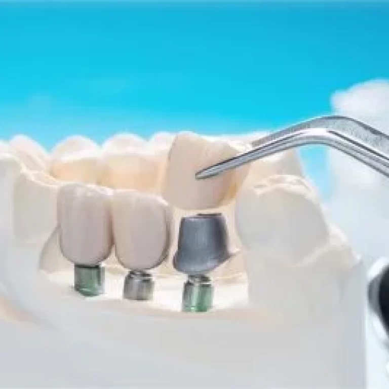 Dental Implants Clinic