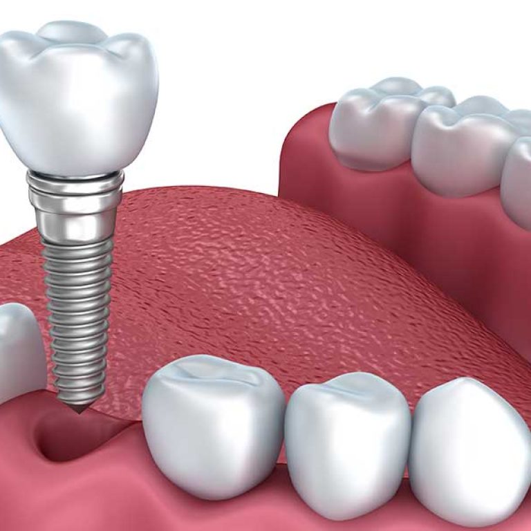 Full Mouth Dental Implants