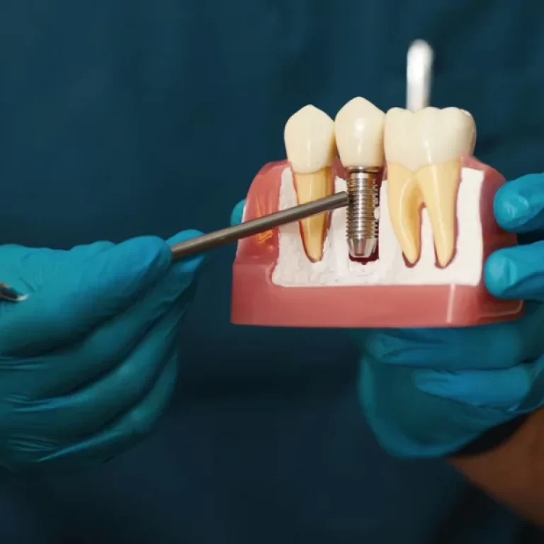 Post Dental Implants